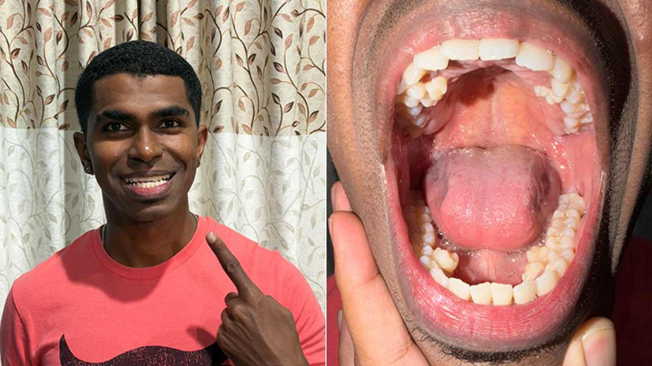 Man With Most Teeth